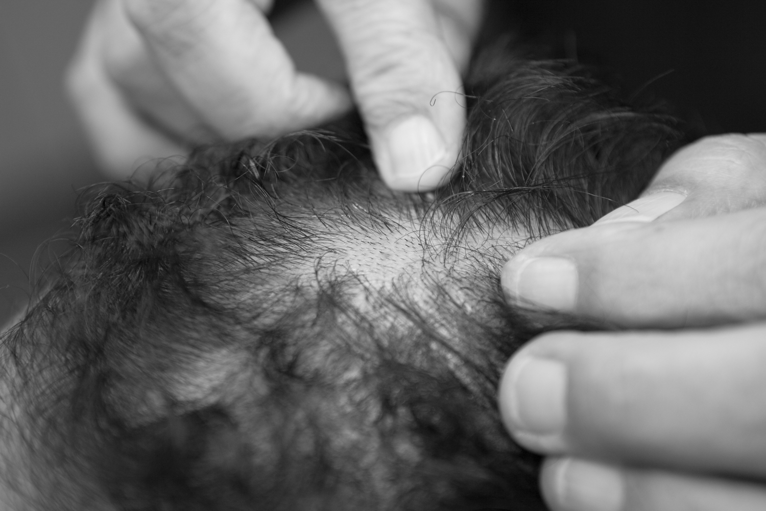 PRFM - Reinvigorate Dormant Hair Follicles Promoting Hair Growth - ANEW -  טיפול IPRF - הדור החדש של טיפול PRP, טיפול בהתקרחות, הצמחת שיער